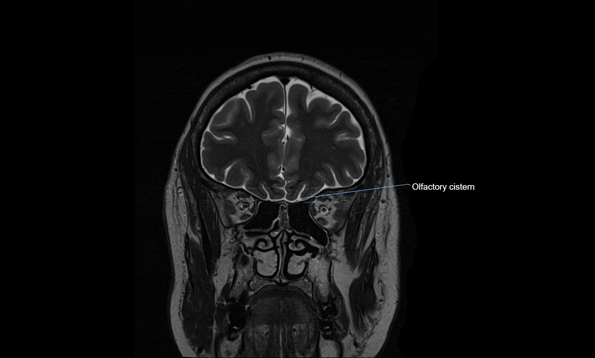 Brain cisterns  and ventricles coronal anatomy 3T MRI image-img-00001-00010.webp